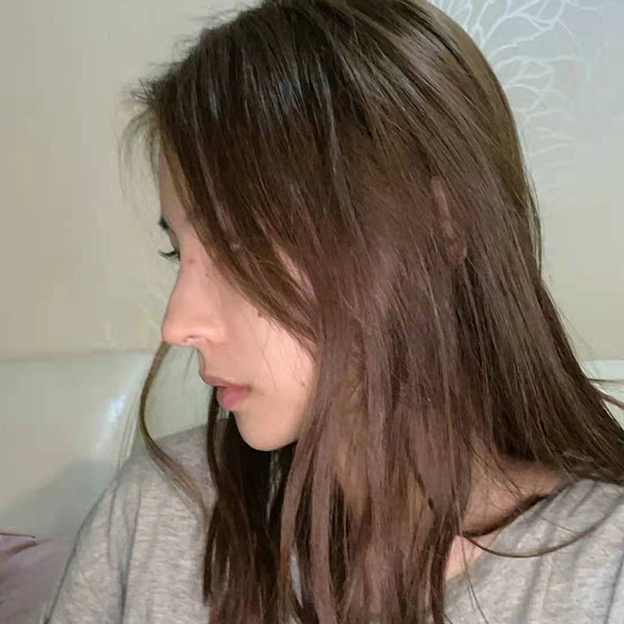 我属于遗传性的款鼻翼低鼻梁,所以在小时候就很羡慕那_圈子-新氧美容