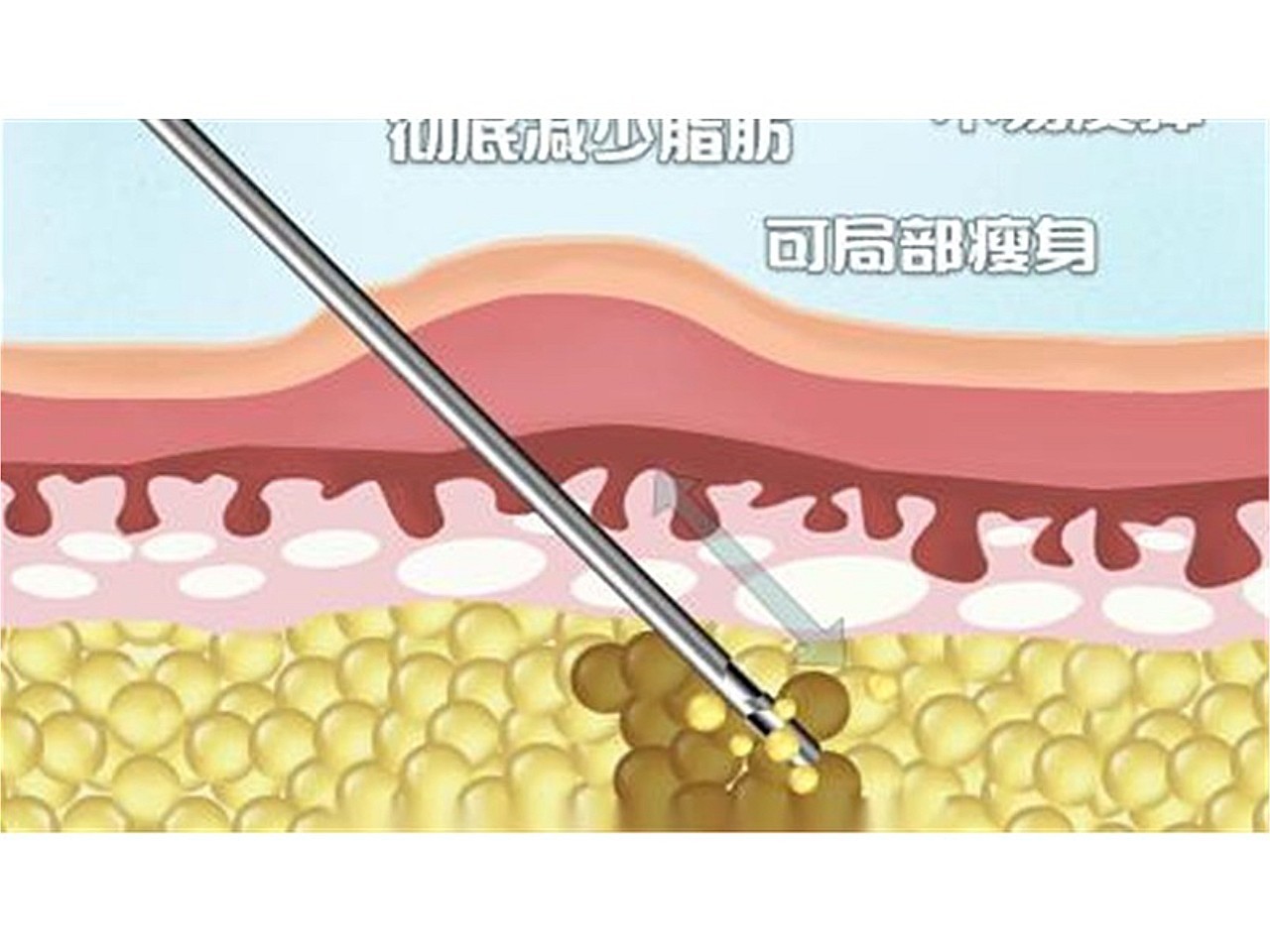 缓解吸脂术后疼痛的措施吸脂手术切口较小,术后恢复较_圈子-新氧美容