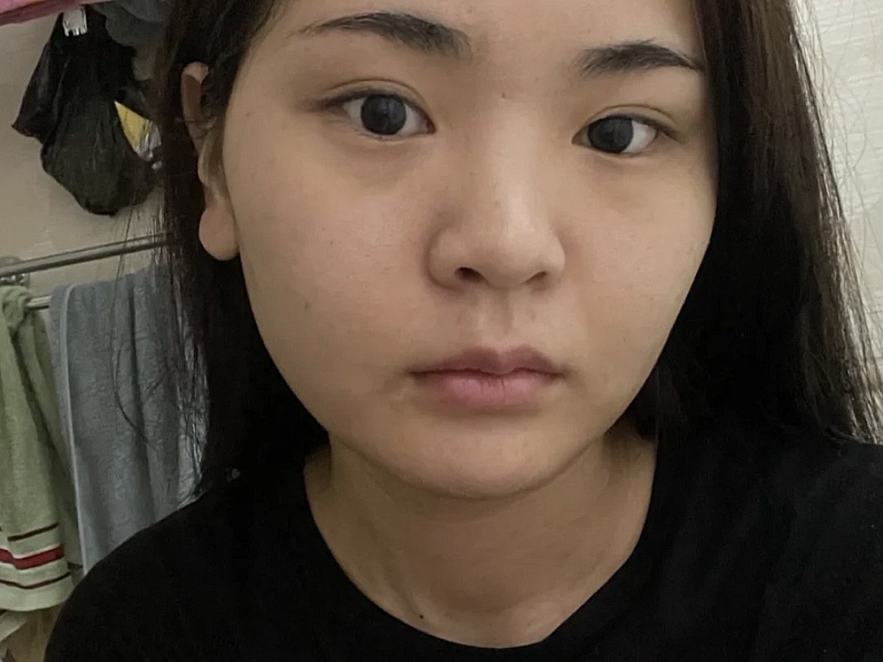 (体验前诉求)下巴比较兜,侧面看显胖显老气,打了瘦_圈子-新氧美容整形