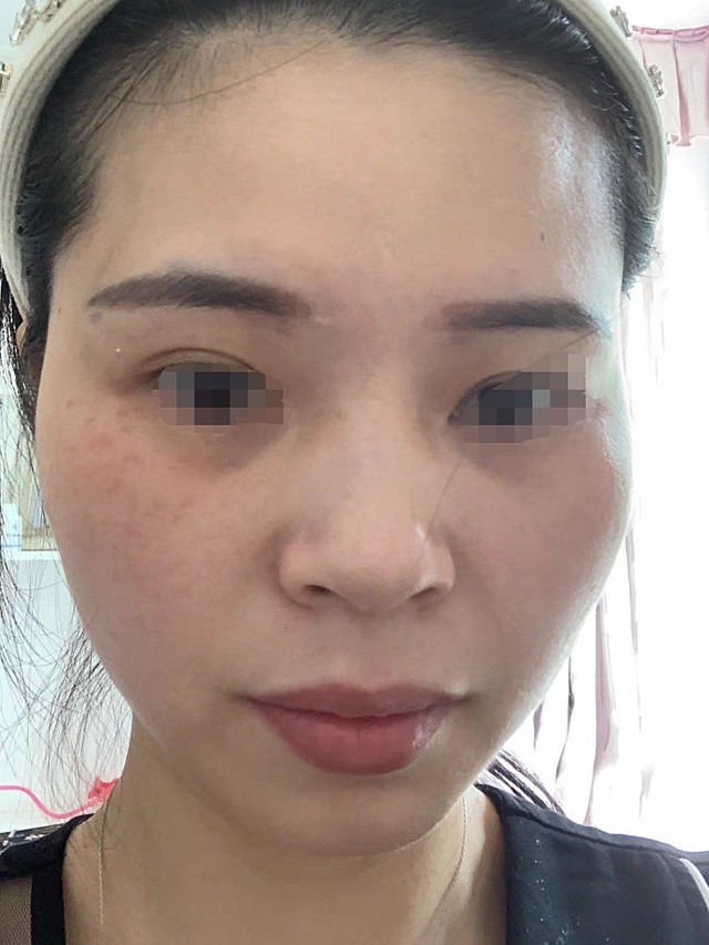 脸上的斑点也不知道具体是什么斑,反正是在颧骨处,看_圈子-新氧美容