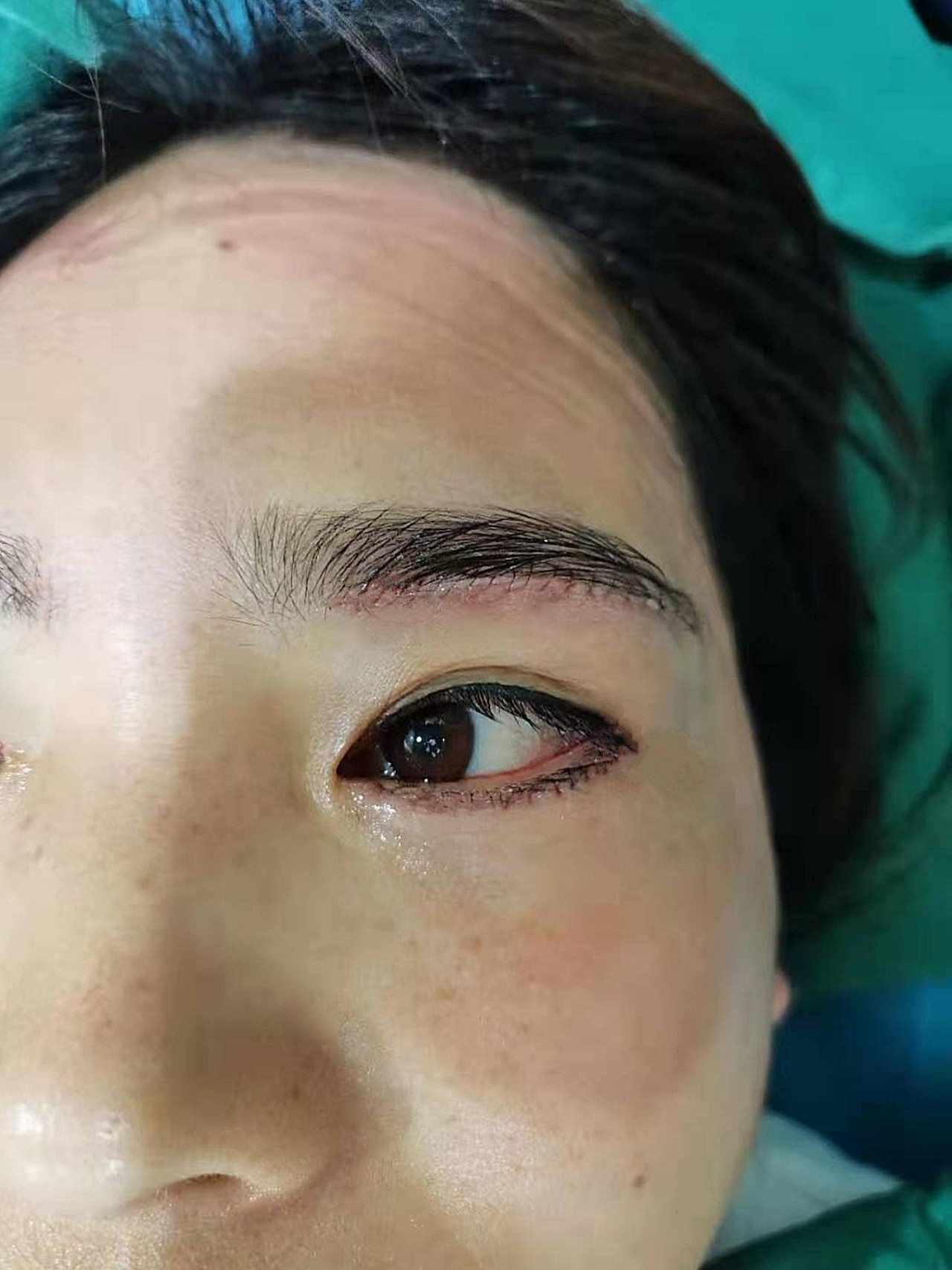 上眼睑松弛下垂,眼袋膨出松弛.