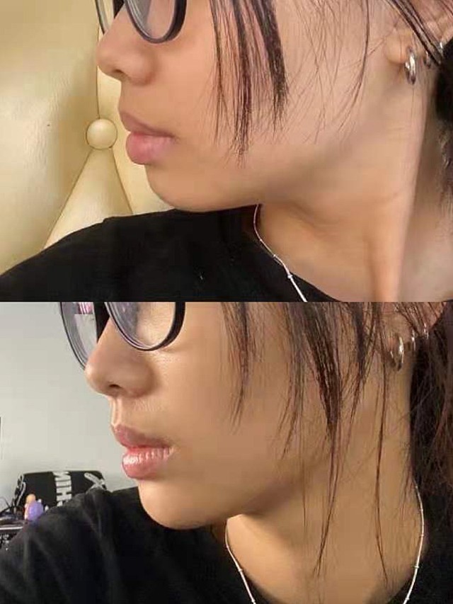 玻尿酸打的下巴,林千里主任打的,效果确实立竿见影!