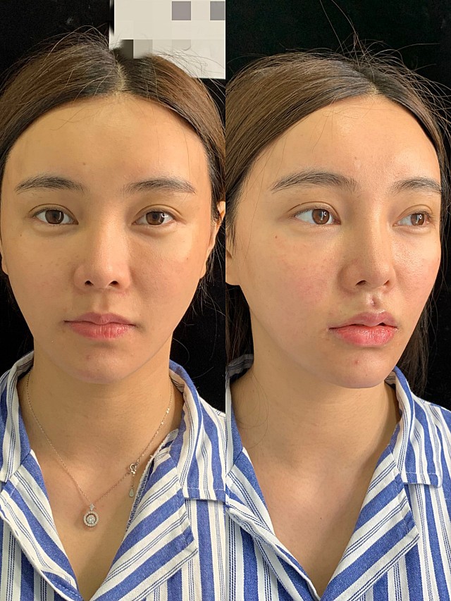 我的人中虽然有点形状,但人中沟就很浅很平,没有美感_圈子-新氧美容