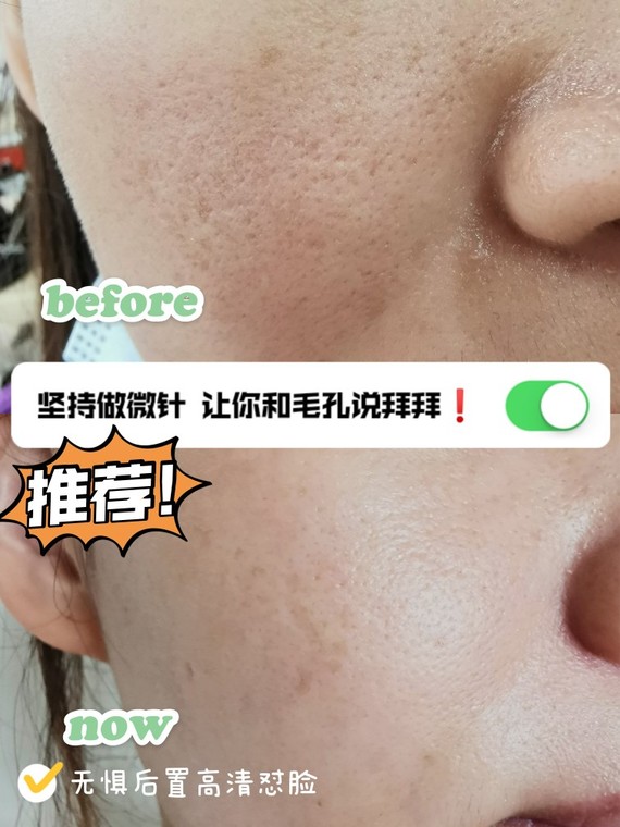 我首选中胚层疗法微针美塑