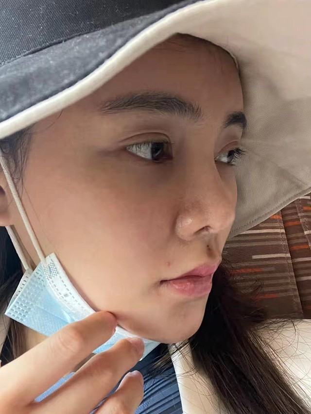 我的人中虽然有点形状,但人中沟就很浅很平,没有美感_圈子-新氧美容