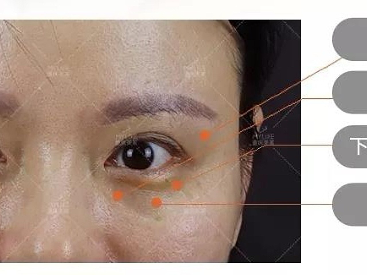 眼周松弛泪沟明显下睑细纹明显黑眼圈严重