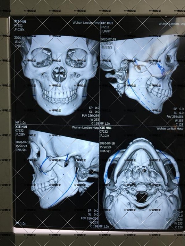 体验项目颧骨颧弓内推下颌角超长截骨