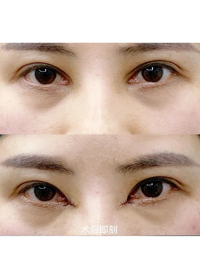 哪些情况下内眼角要修复