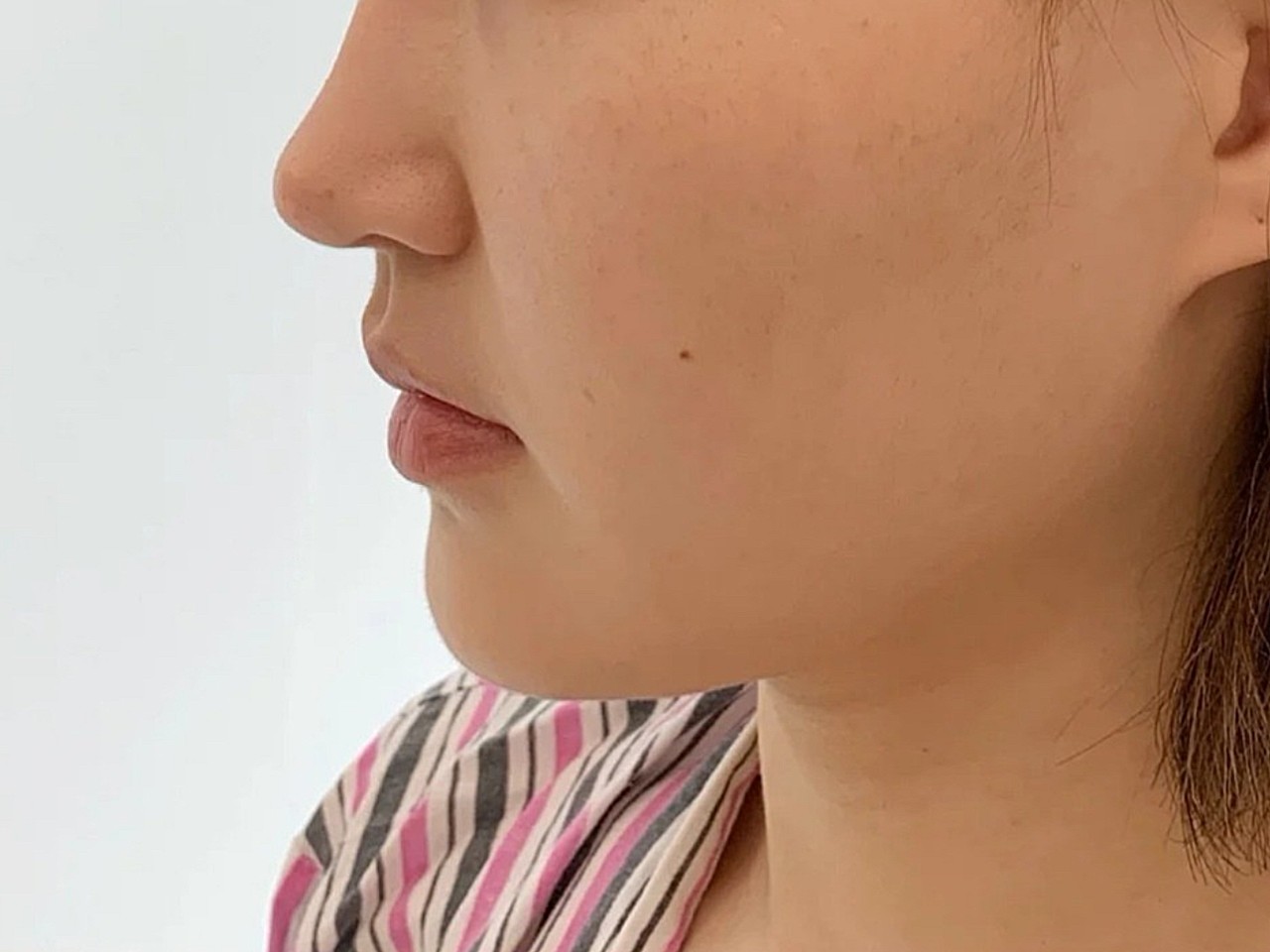 诊断:求美者鼻翼基底凹陷,视觉上侧面显面中凹陷,法令纹深.