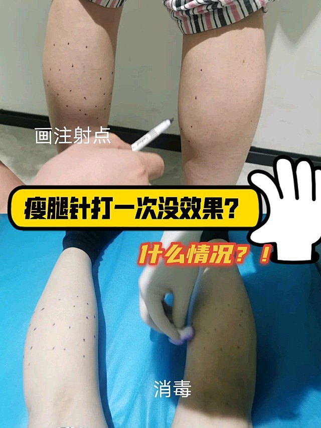 7月优质功课看这里小美在一个多月前打了瘦腿针