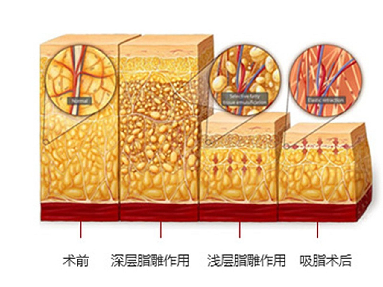 腰腹部吸脂术是解决腰腹部脂肪堆积的一种效果较为确切的方法,适用于