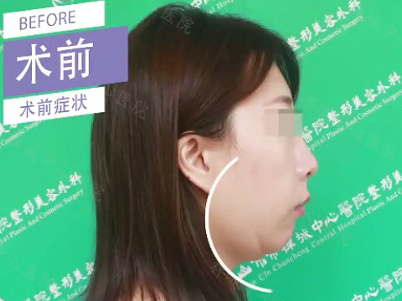 没下巴,下巴短还后缩,双下巴明显