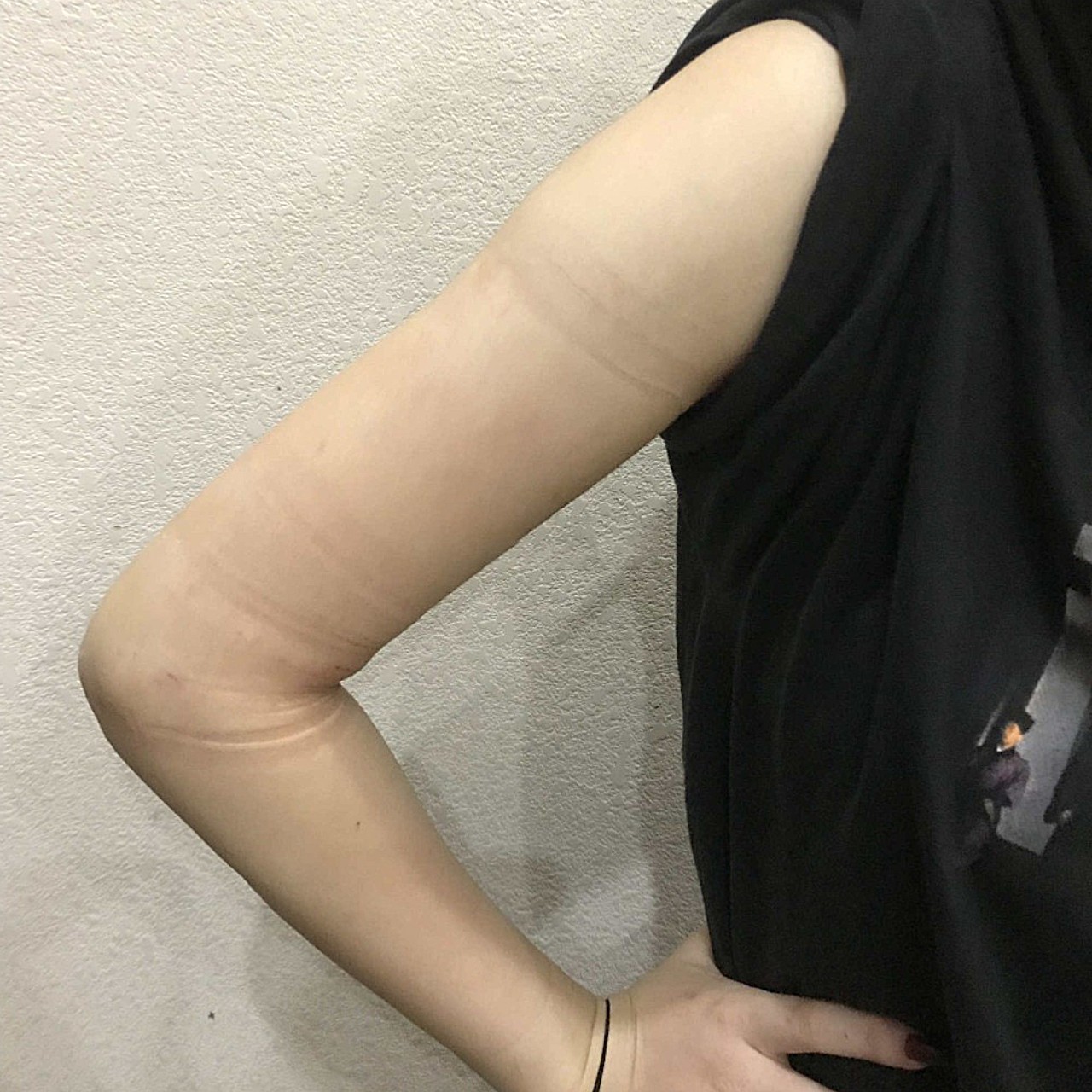 [:163]体验前变美诉求:从小到大,天生的粗手臂_圈子-新氧美容整形