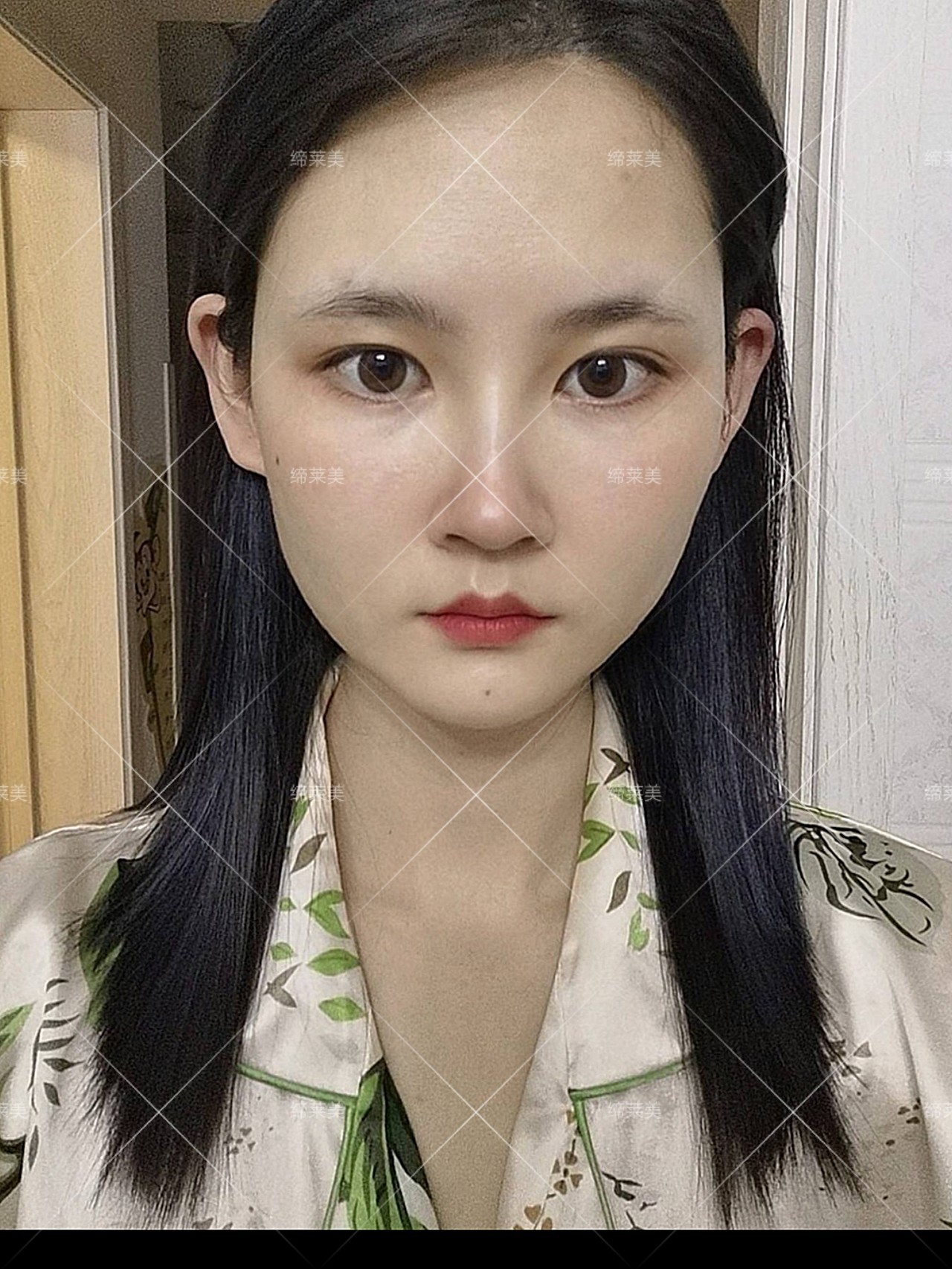 术前诊断川字纹动态明显,显凶显老态方案设计除皱针注_圈子-新氧美容