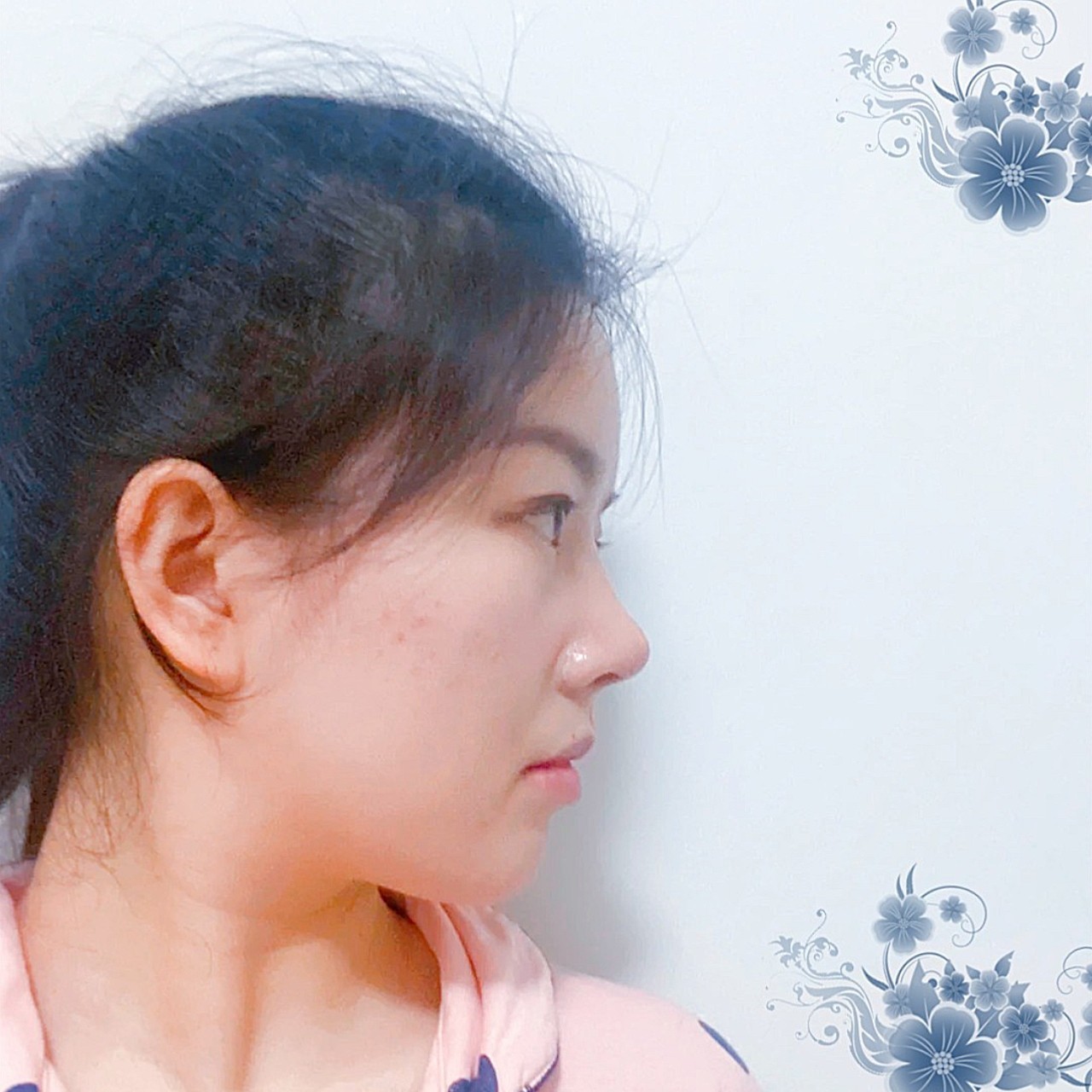 术前鼻子正面看就是鼻翼比较宽,侧面山根低,鼻尖也低_圈子-新氧美容