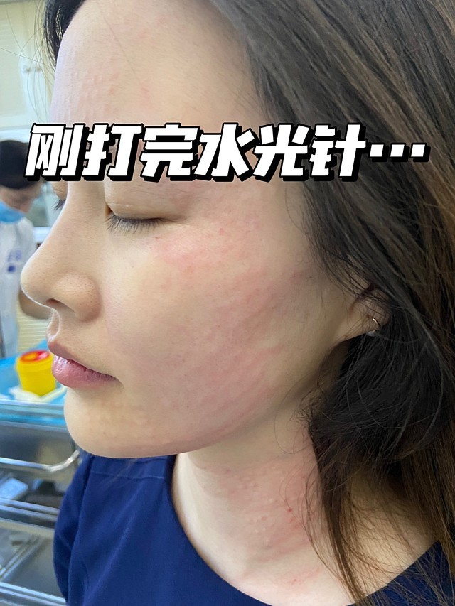 刚打完水光补水,脸上坑坑洼洼.【以下来自顾客_圈子-新氧美容整形