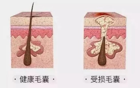 毛囊堵塞怎么办?|得靠刷酸来帮忙!