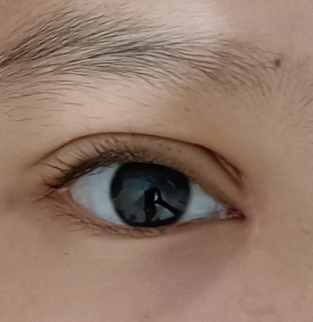 埋线之后,医生发现眼头不对称,在右眼角多加了一针.