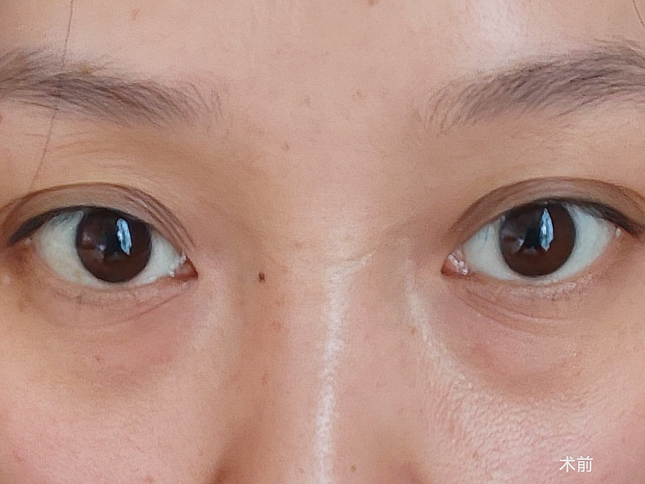 天生眼袋一直想去掉的看网上都是褒贬不一手术前很忐忑鼓起勇气还是去