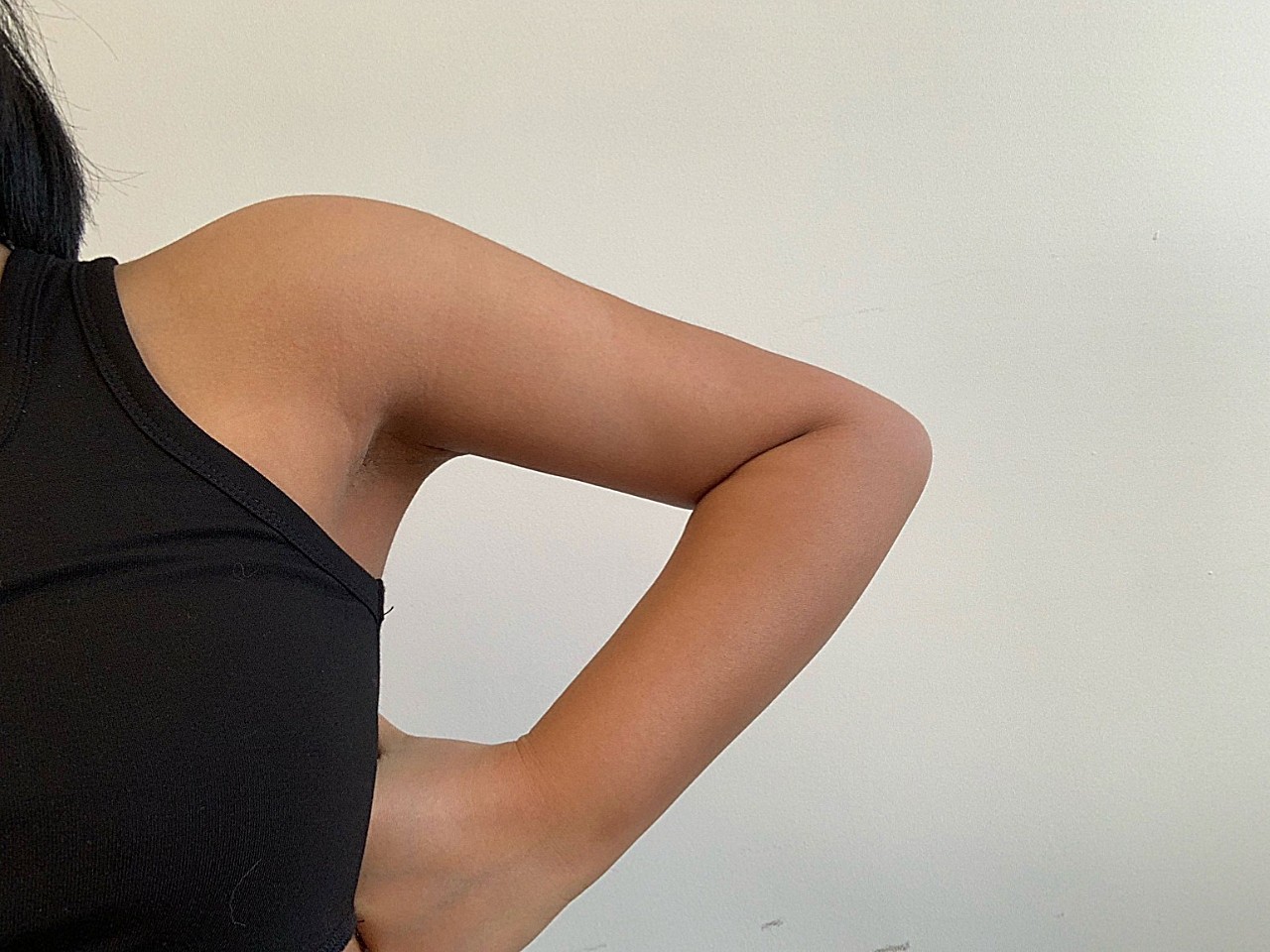 手臂吸脂后皮肤变鸡皮(手臂吸脂多久能恢复成正常皮肤)