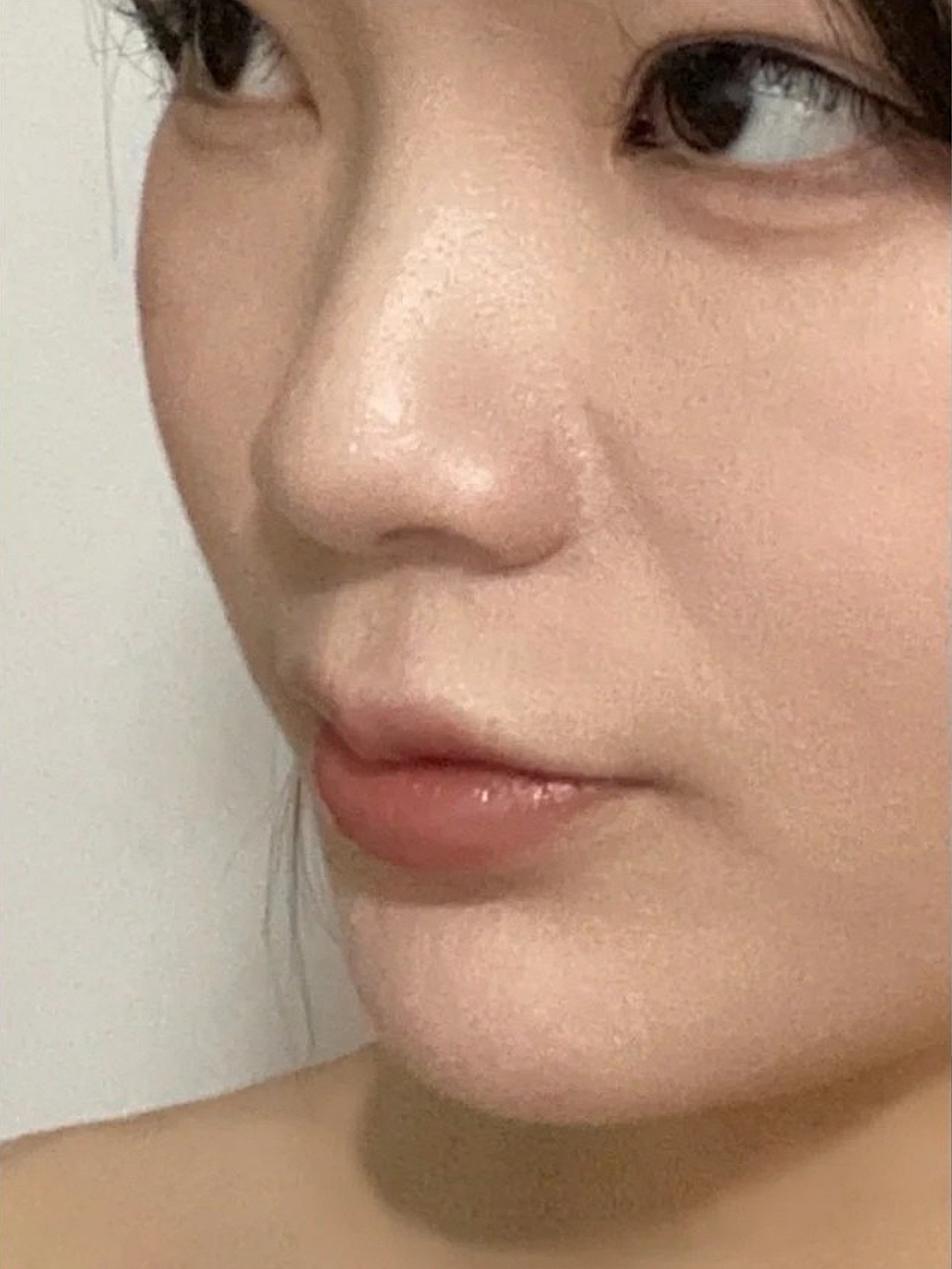 诊断:求美者法令纹凹陷明显,面中部显老态.