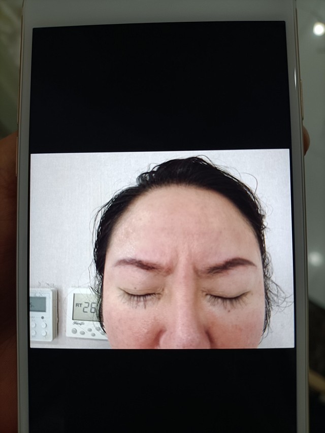 平时爱皱眉,眉头凹陷很明显,上次过来打过印第安纹效_圈子-新氧美容
