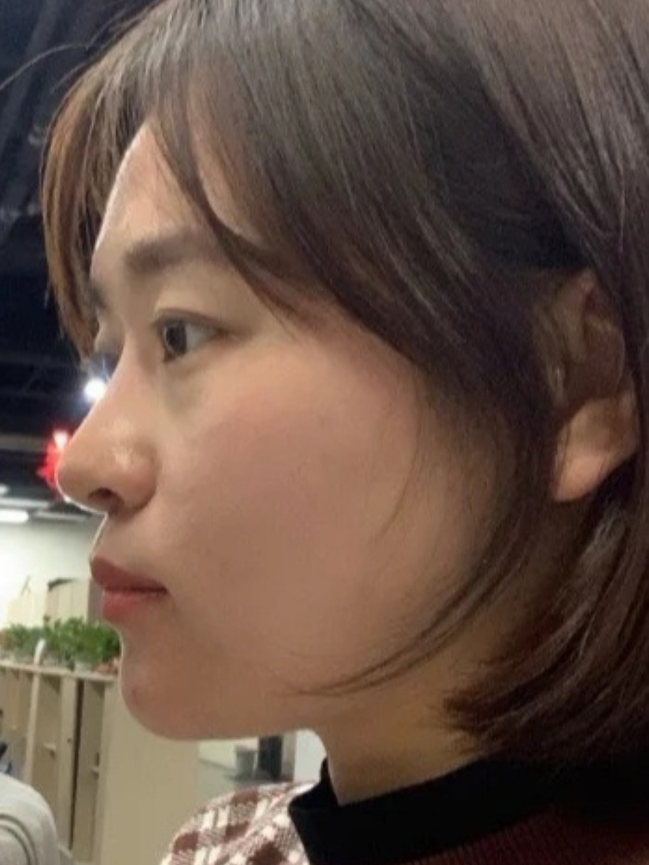 诊断:求美者下巴后缩,显凸嘴,下庭长度短,三庭比例不协调,侧面鼻,唇