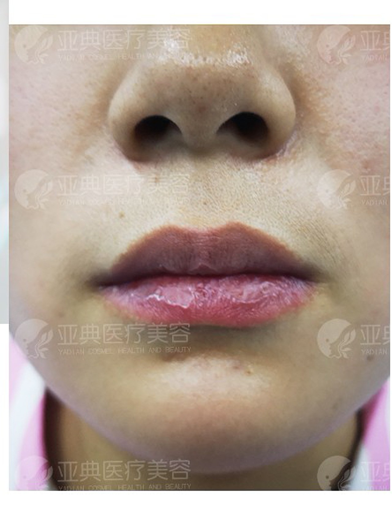 术前诊断唇部线条平直,无明显唇峰,唇谷,唇珠,整体_圈子-新氧美容整形
