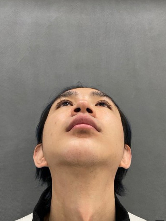 男生做了鼻部多项真的更帅吗?