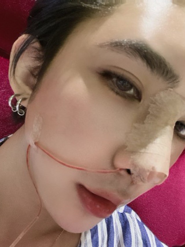男生做了鼻部多项真的更帅吗?