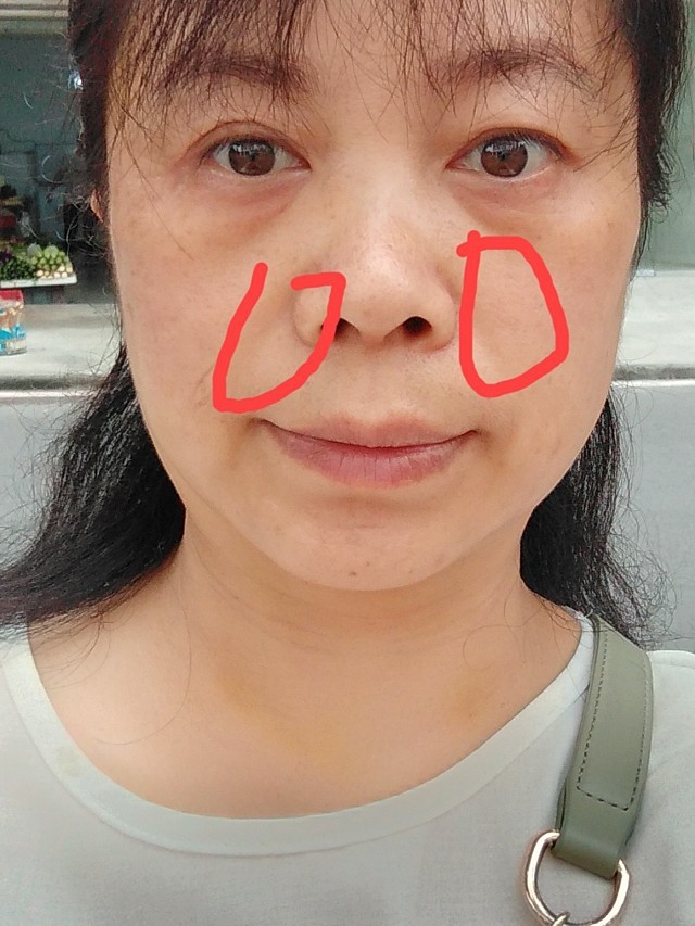 手术前,法令纹特别明显,在没有微笑时,嘴巴与鼻翼两_圈子-新氧美容