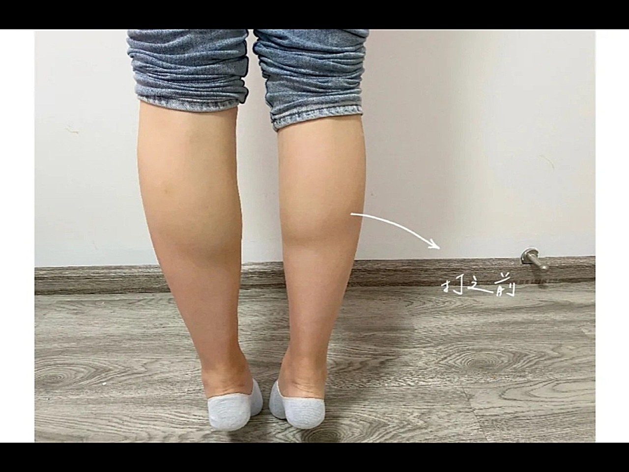 术前诊断诊断:求美者小腿肌肉肥厚发达,腿部线条较差