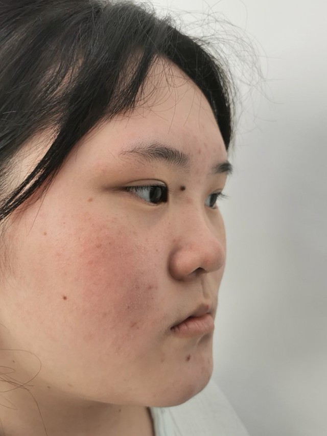 我就是典型的塌鼻梁大蒜鼻,形态特别差,鼻头鼻翼偏大_圈子-新氧美容