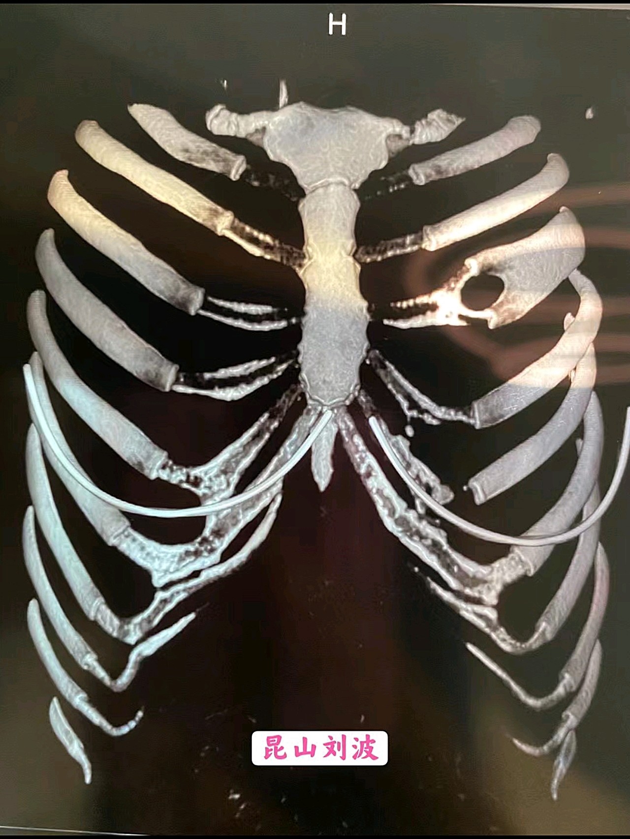 严重挛缩鼻矫正,皮肤移植 钙化肋软骨修复.