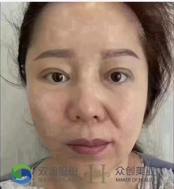 面部提升效果对比