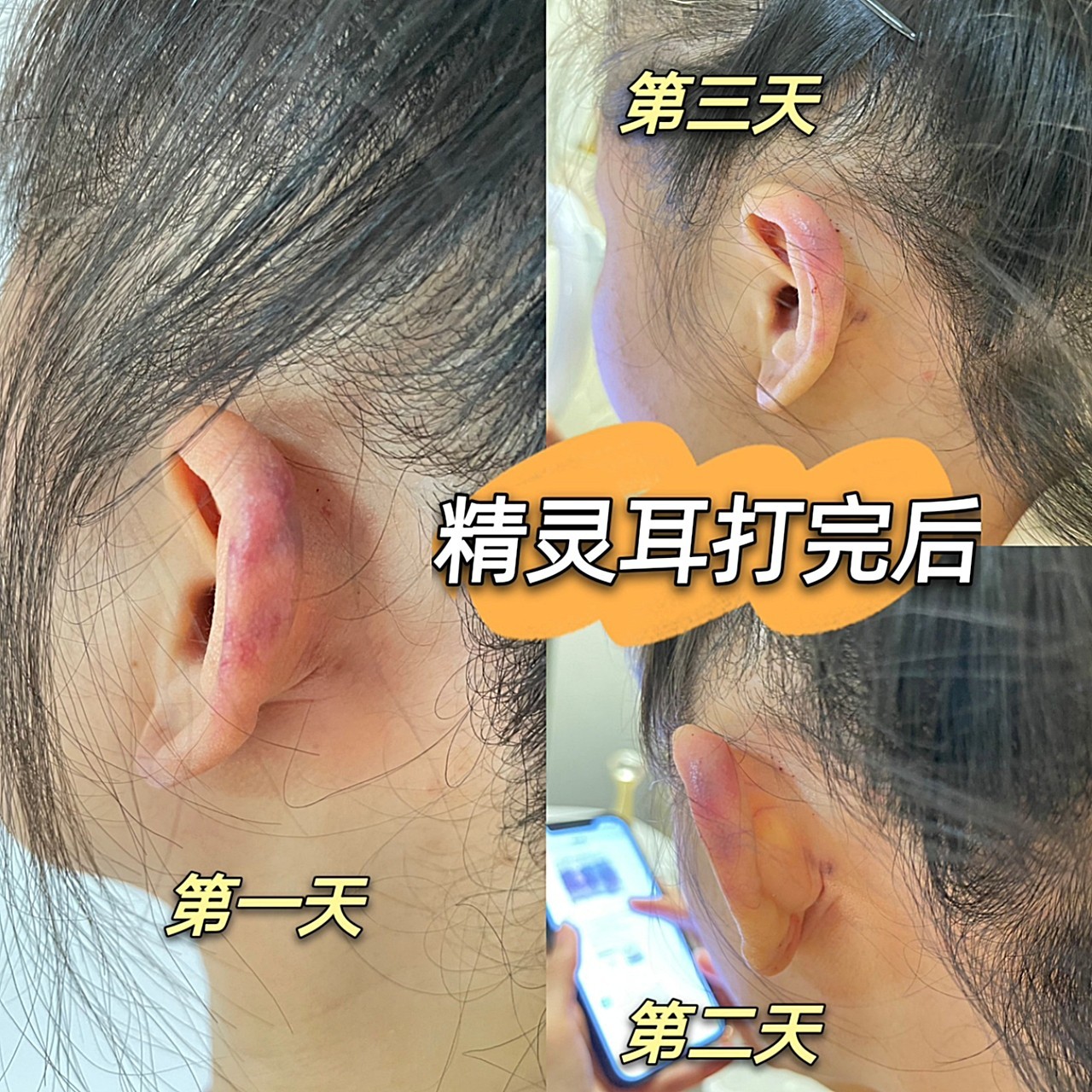 距离上一次打精灵耳_圈子-新氧美容整形