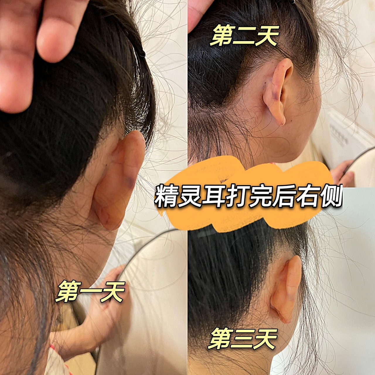 距离上一次打精灵耳_圈子-新氧美容整形