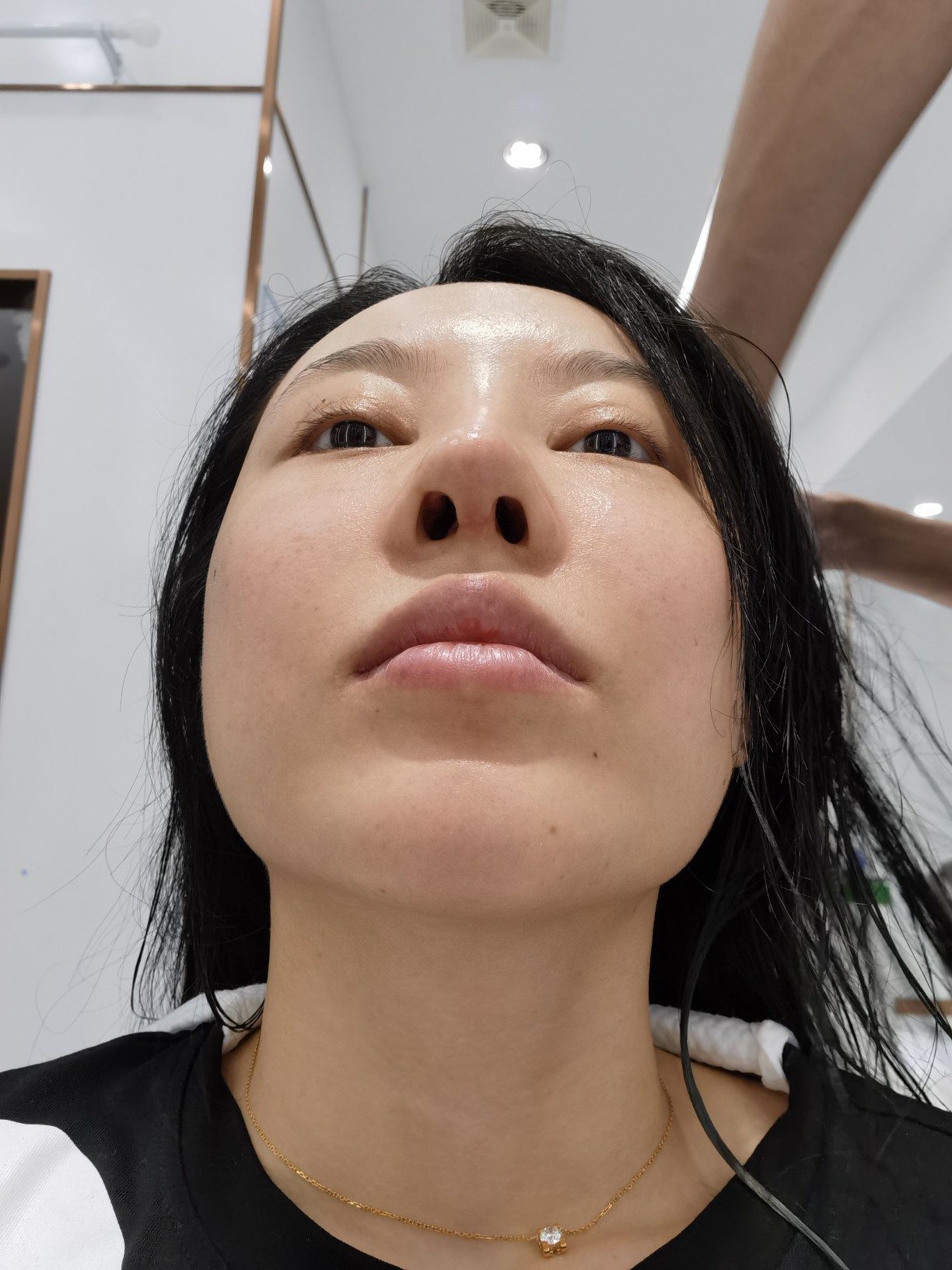 恢复好,鼻孔一大一小,,朋友都说做完还没不做好看,_圈子-新氧美容整形