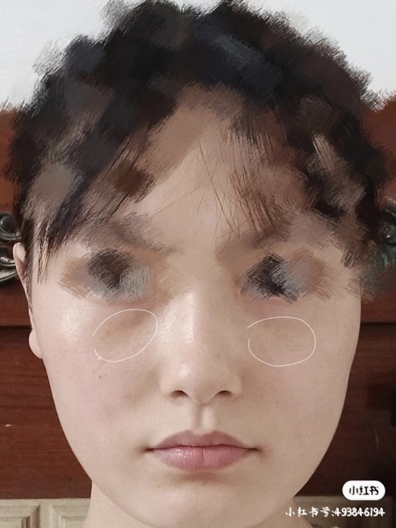 面部扁平我有泪沟嘛我需要填充哪里