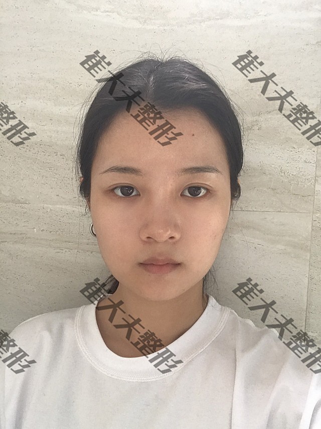 术前诊断求美者术前鼻头圆钝带点蒜头鼻,鼻翼略宽,山_圈子-新氧美容