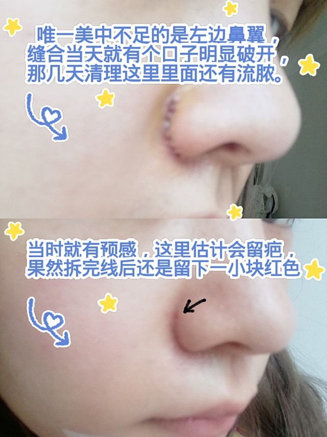今天是拆线第一天啦超级兴奋的是外切鼻翼我还没开始用祛疤药居然也没