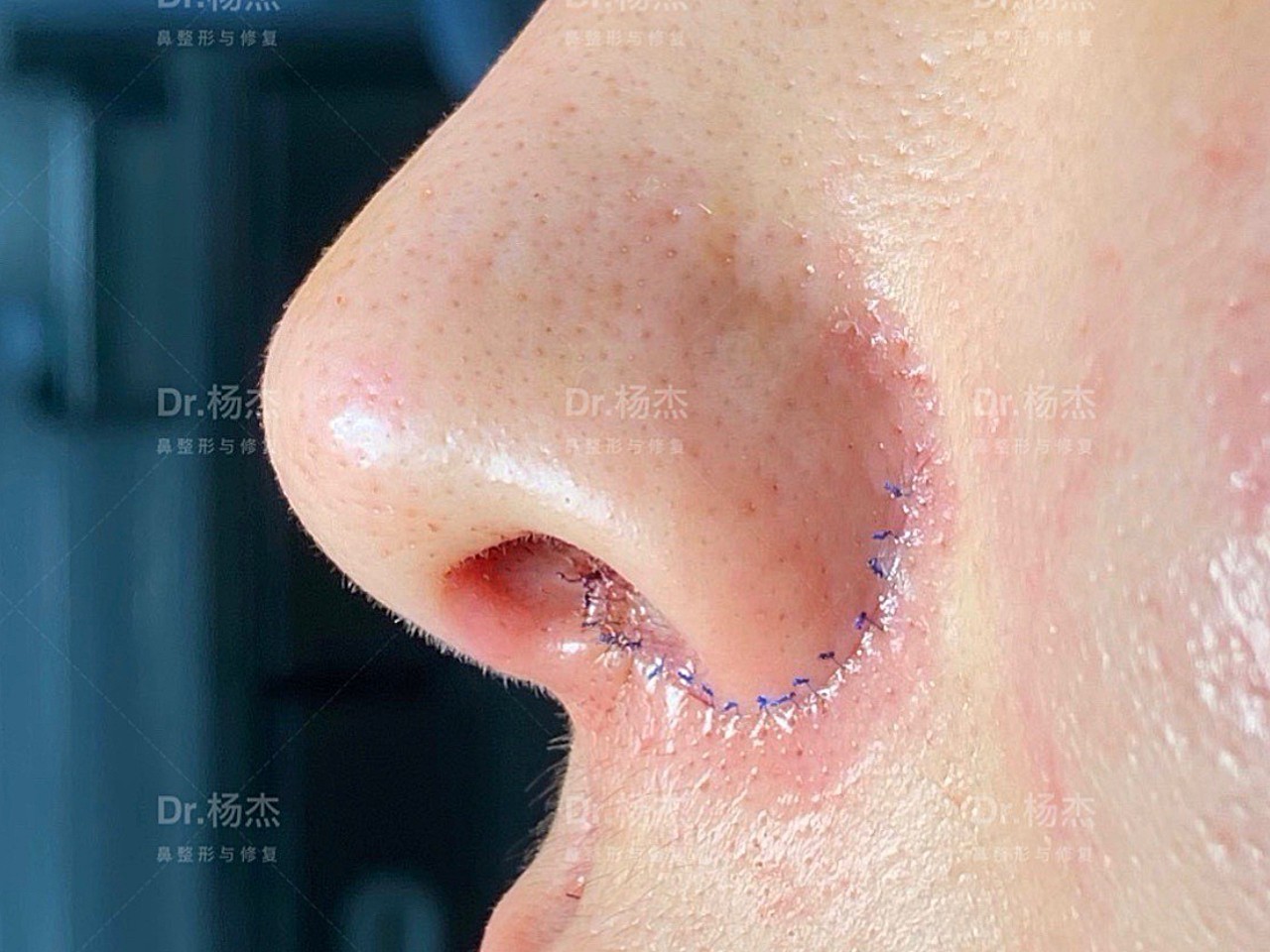 内外联合缩鼻翼术后即时效果缩鼻翼