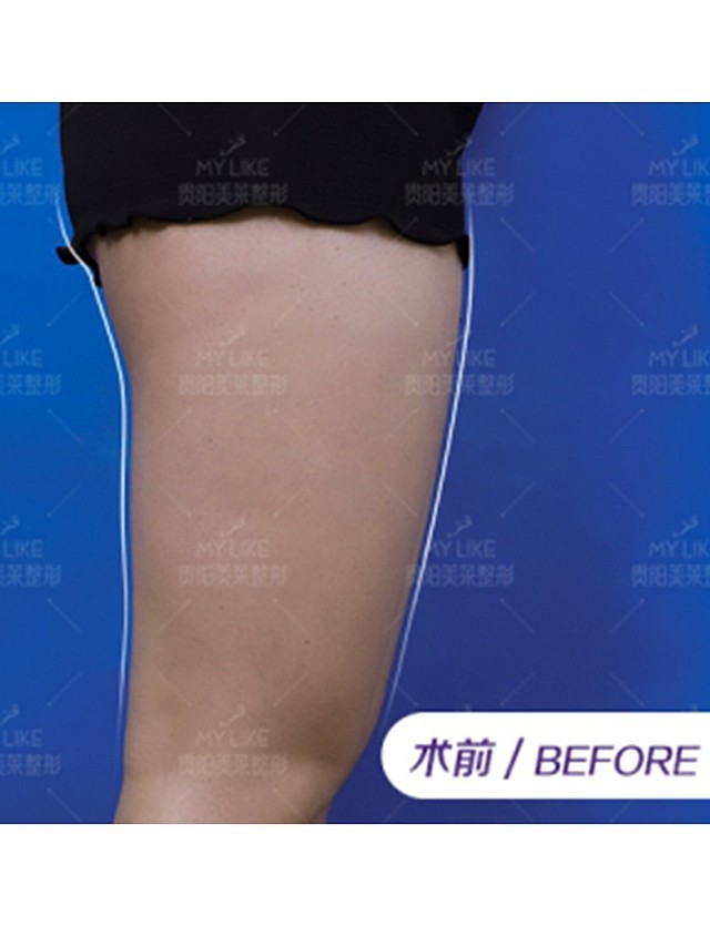 大腿脂肪过多