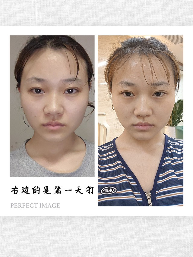 打完瘦脸针后的第五天,还是感觉没啥区别.