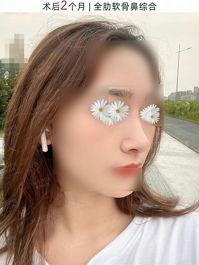 宛若天生的妈生美鼻78医美大赏隆鼻