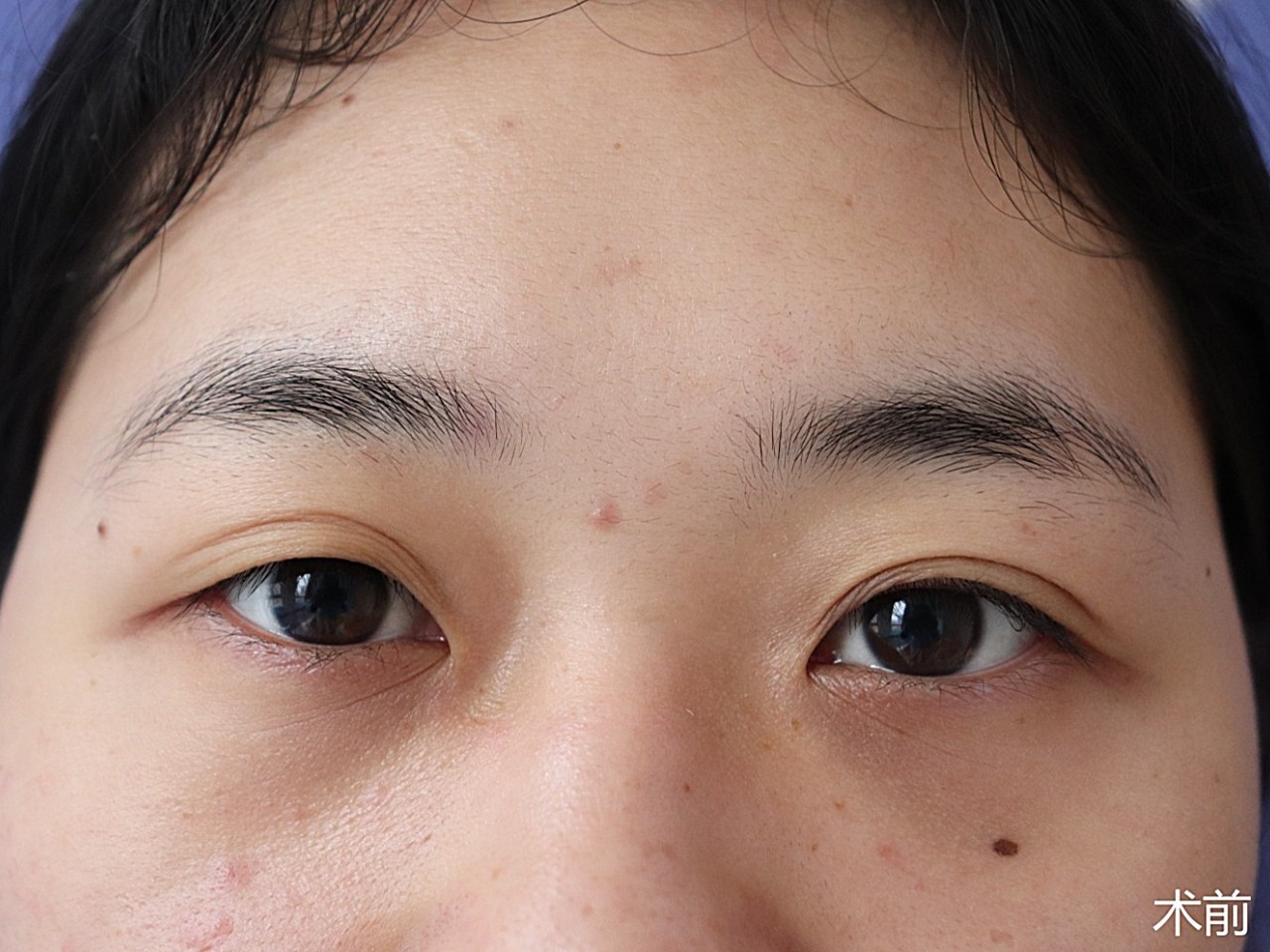 术前诊断术前双眼不对称,上眼睑肌无力的原因导致上睑