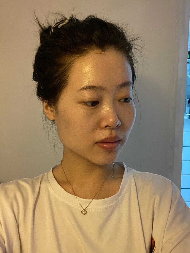 脸型不对称,咬肌较大