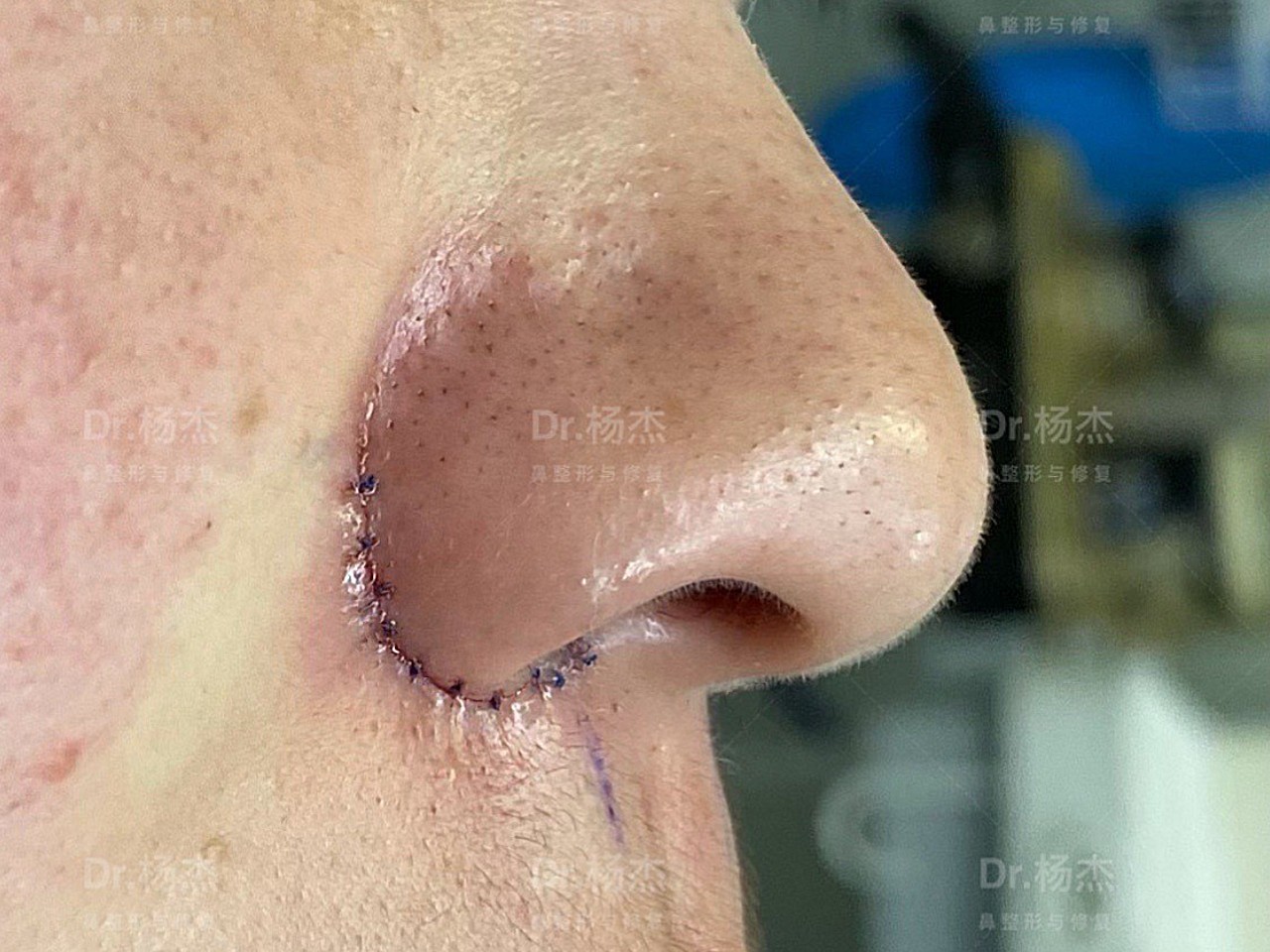 【内外联合鼻翼缩小】手术采取鼻翼内外联合切除:1.
