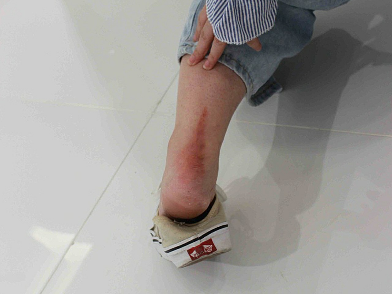 我脚后跟这里是好小好小的时候被烫伤的哦,自己当然没_圈子-新氧美容