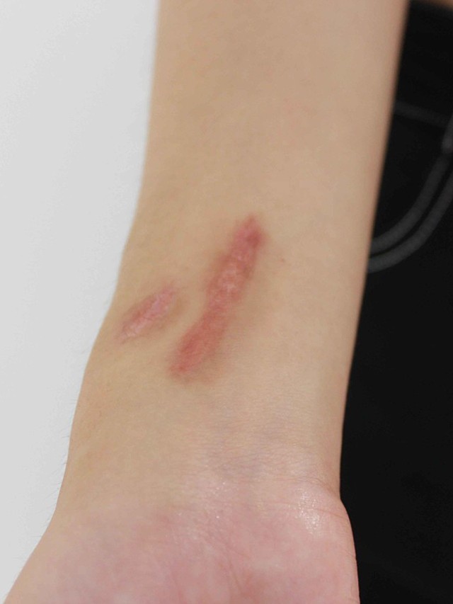 我手臂内侧这一条长的,一个圆的疤痕是意外烫伤导致的